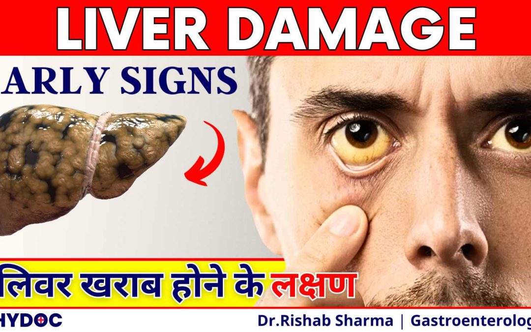 Liver Kharab Hone Ke Lakshan | Liver Cirrhosis Early signs | Liver Damage Signs and Symptoms
