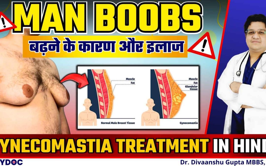 Gynecomastia का इलाज | मैन बूब्स का इलाज और कारण | Gynecomastia का कारण | Gynecomastia in Hindi