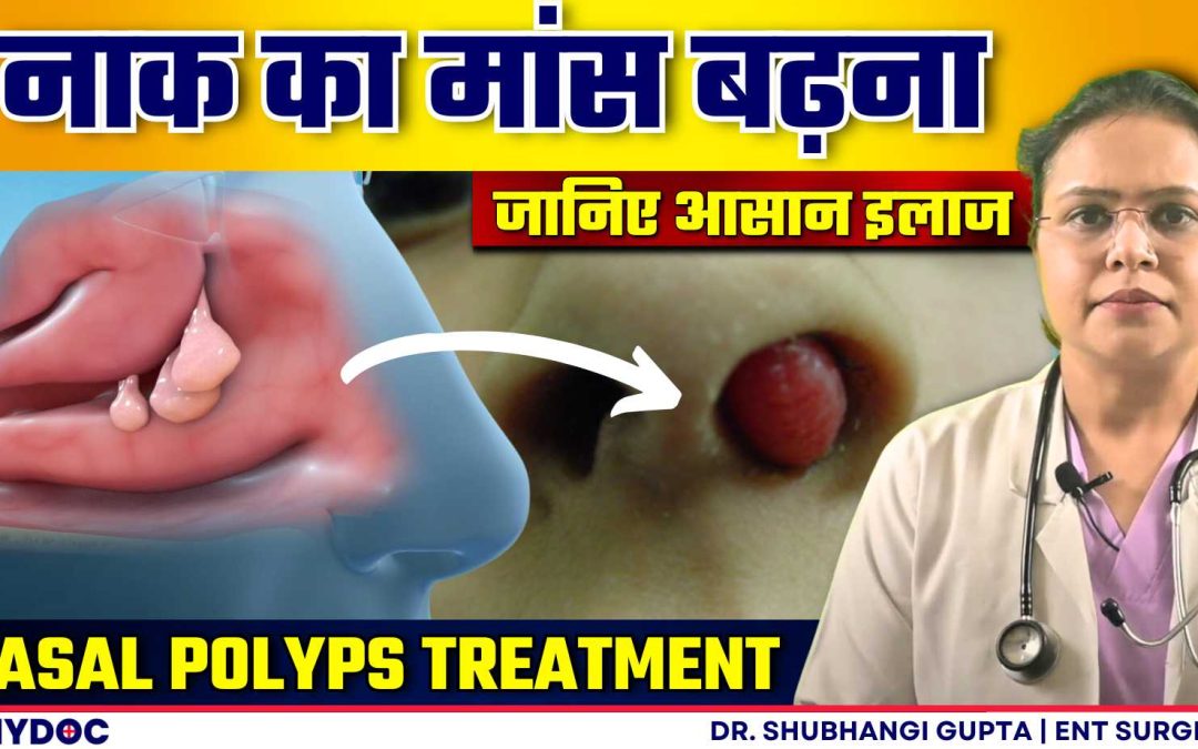 Nasal Polyps | नाक की गाठ या नाक में मांस बढने के लक्षण, उपचार और इलाज | Nasal Polyps Treatment