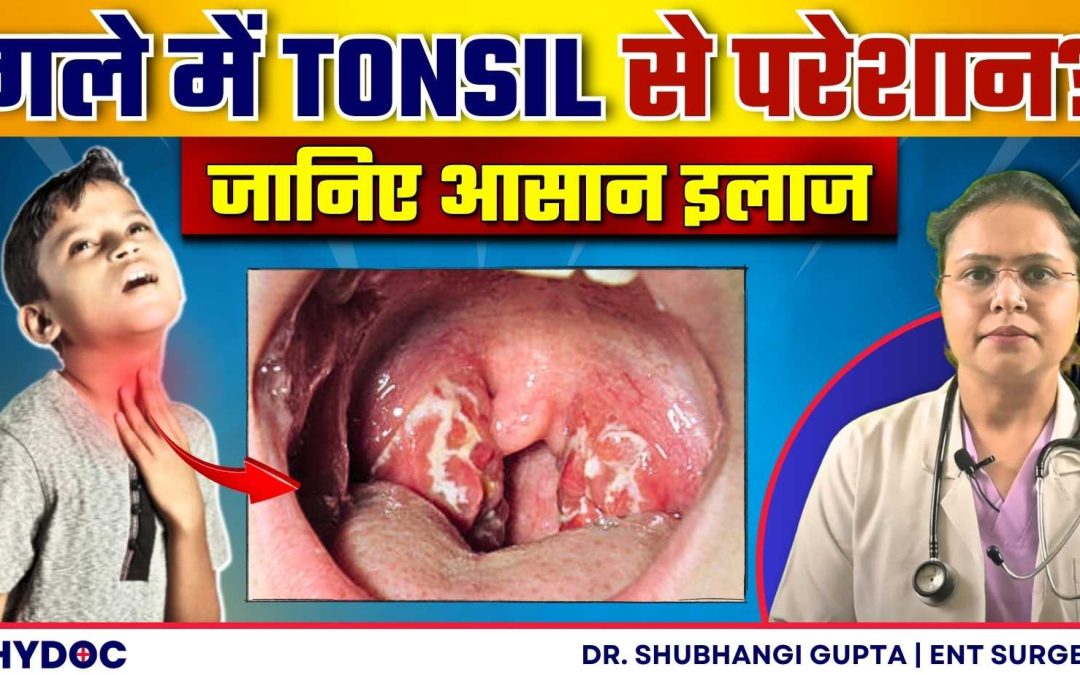 गले में दर्द, सूजन से परेशान? | जानिए Tonsil के कारण और इलाज | Tonsillitis Treatment and Causes