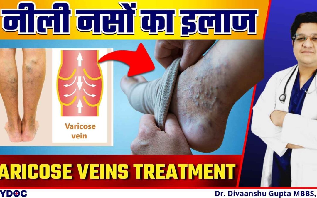 पैर की नीली पड़ी फूली नसों का इलाज | Varicose Veins Treatment and Causes Hindi | नीली नसों का इलाज
